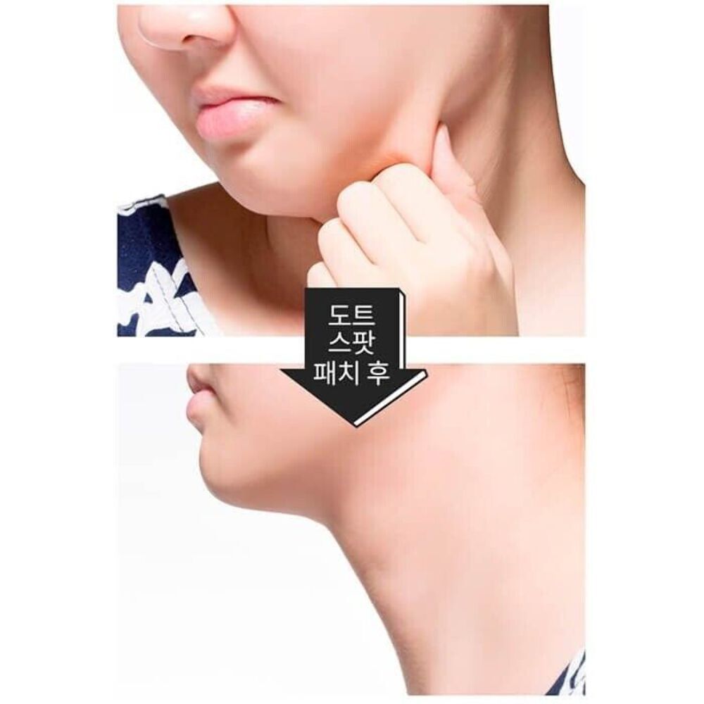 3 X A'PIEU Dot Spot V Patch + *FREE BONUS* MISSHA Speedy Solution Face Up Patch